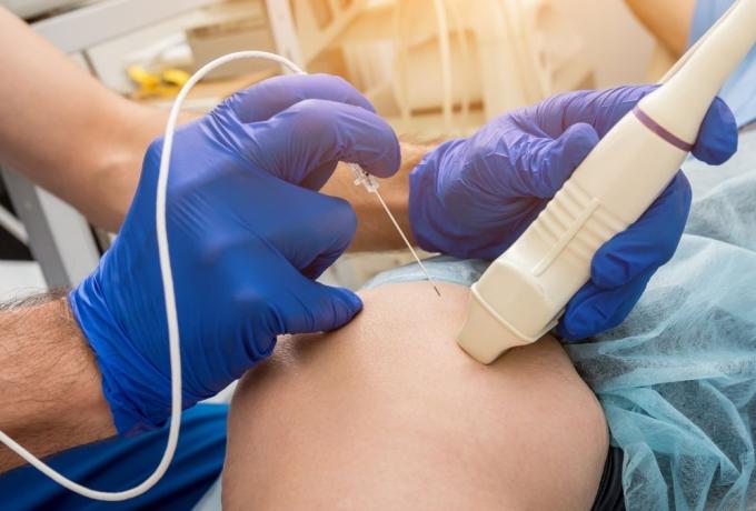 Doctor administers radiofrequency ablation treatment to Phoenix, AZ personal injury patient.